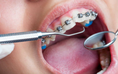 Get The Best Dental Treatment With Braces Duncan